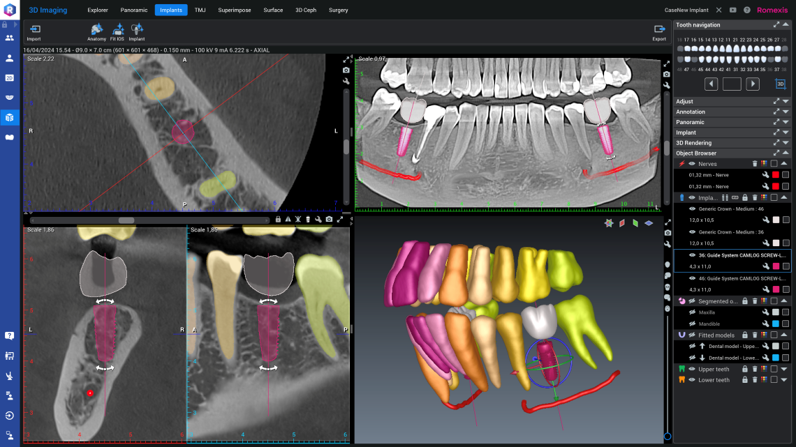 RXS7_Smart_Implant.png
